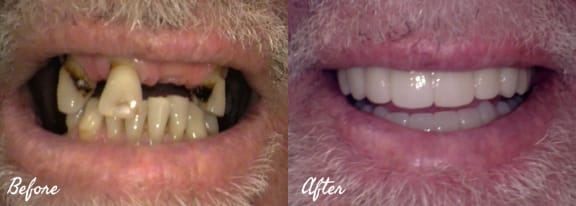 Before and after — an actual Tomlinson Dental patient
