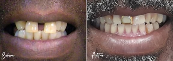 Before and after — an actual Tomlinson Dental patient
