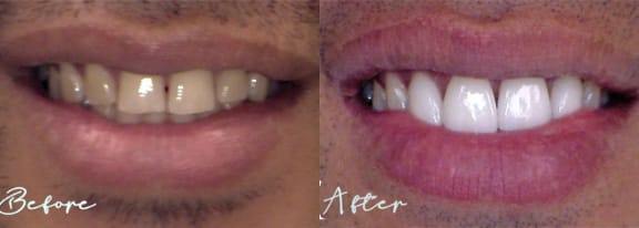 Before and after — an actual Tomlinson Dental patient