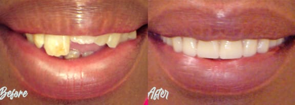Before and after — an actual Tomlinson Dental patient