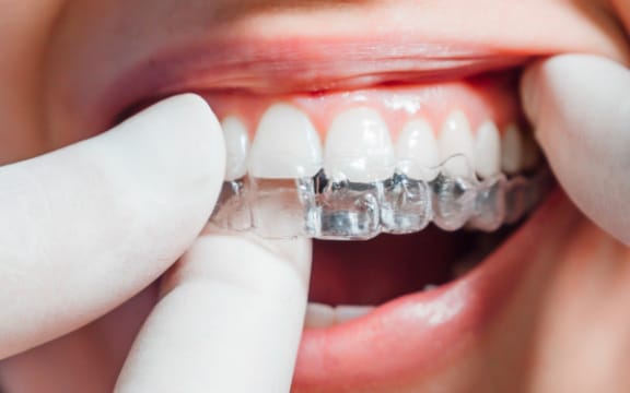 Before and after: a patient's crowded front teeth straightened with clear aligners at Tomlinson Dental in Tampa