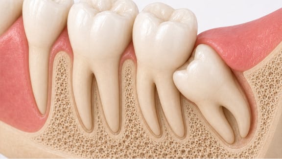 A dentist reviewing wisdom tooth positioning on an X-ray with a patient