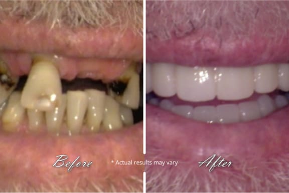 Before and after: a missing tooth replaced with a natural-looking dental implant at Tomlinson Dental in Tampa