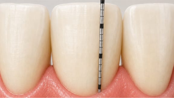 A periodontal chart showing pocket-depth measurements