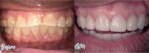 Before and after: a missing front tooth replaced with a natural-looking dental implant at Tomlinson Dental in Tampa