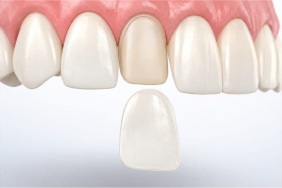 Porcelain veneer placed over a front tooth